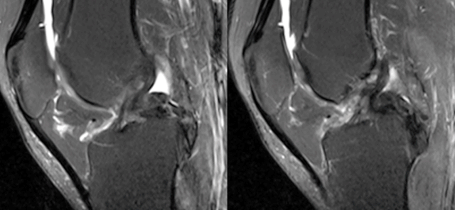 干货：高清动图学前交叉韧带MRI诊断，经典珍藏版！