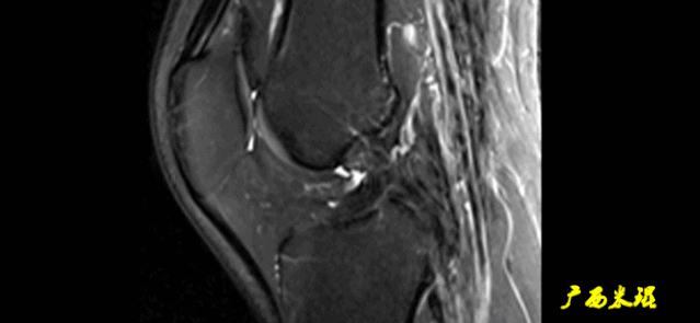 干货：高清动图学前交叉韧带MRI诊断，经典珍藏版！
