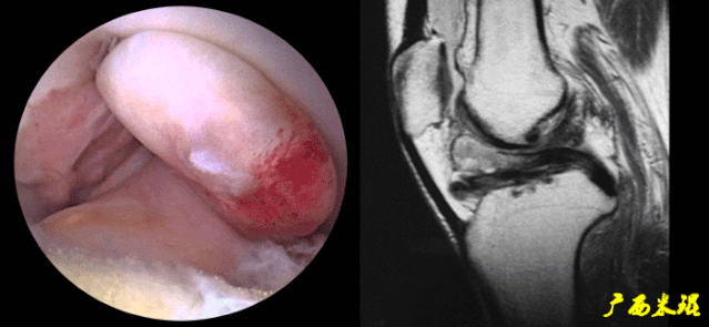 干货：高清动图学前交叉韧带MRI诊断，经典珍藏版！