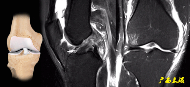干货：高清动图学前交叉韧带MRI诊断，经典珍藏版！