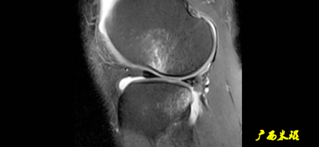干货：高清动图学前交叉韧带MRI诊断，经典珍藏版！