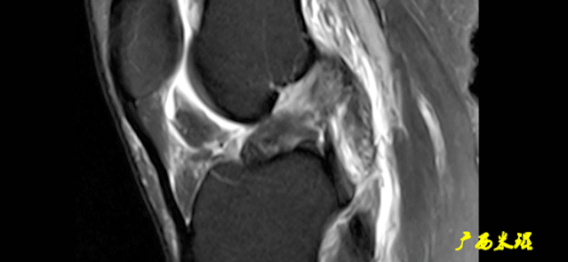 干货：高清动图学前交叉韧带MRI诊断，经典珍藏版！