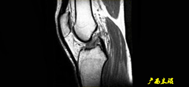 干货：高清动图学前交叉韧带MRI诊断，经典珍藏版！