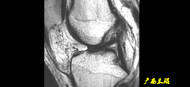 干货：高清动图学前交叉韧带MRI诊断，经典珍藏版！