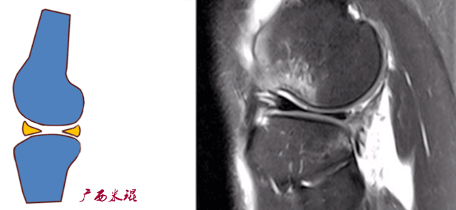 干货：高清动图学前交叉韧带MRI诊断，经典珍藏版！