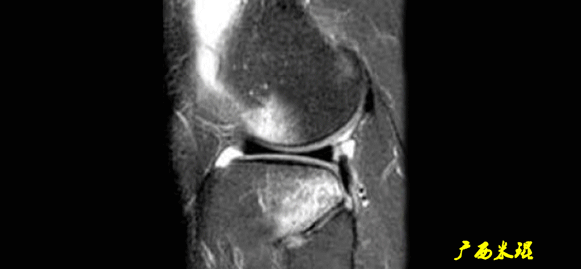 干货：高清动图学前交叉韧带MRI诊断，经典珍藏版！