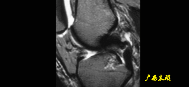干货：高清动图学前交叉韧带MRI诊断，经典珍藏版！