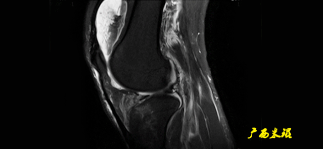 干货：高清动图学前交叉韧带MRI诊断，经典珍藏版！