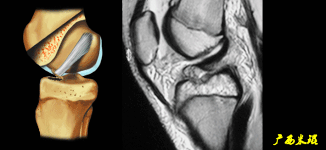 干货：高清动图学前交叉韧带MRI诊断，经典珍藏版！