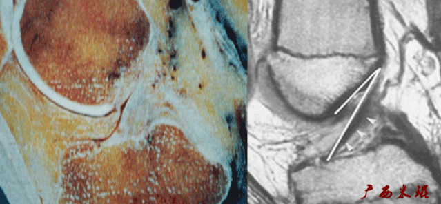干货：高清动图学前交叉韧带MRI诊断，经典珍藏版！