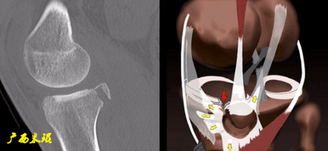 干货：高清动图学前交叉韧带MRI诊断，经典珍藏版！