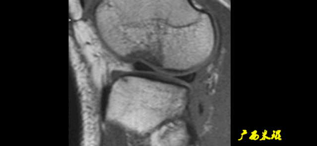 干货：高清动图学前交叉韧带MRI诊断，经典珍藏版！