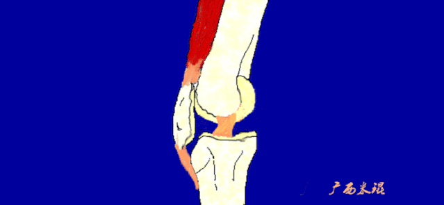 干货：高清动图学前交叉韧带MRI诊断，经典珍藏版！
