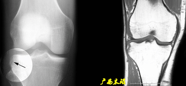 干货：高清动图学前交叉韧带MRI诊断，经典珍藏版！