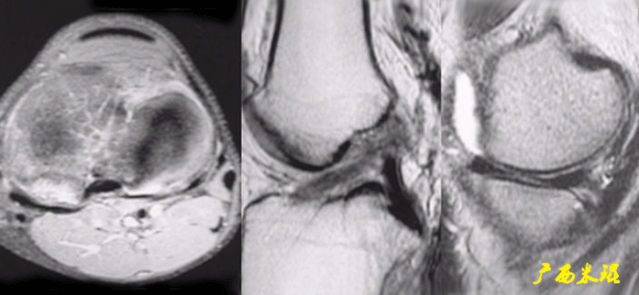 干货：高清动图学前交叉韧带MRI诊断，经典珍藏版！