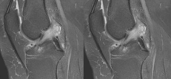 干货：高清动图学前交叉韧带MRI诊断，经典珍藏版！