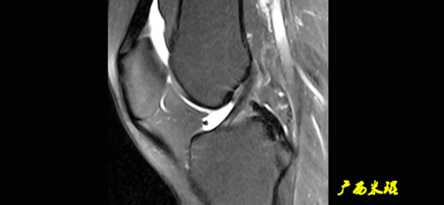 干货：高清动图学前交叉韧带MRI诊断，经典珍藏版！