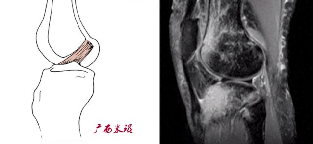 干货：高清动图学前交叉韧带MRI诊断，经典珍藏版！