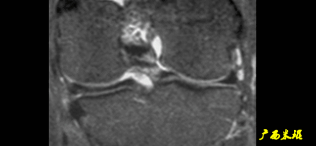 干货：高清动图学前交叉韧带MRI诊断，经典珍藏版！