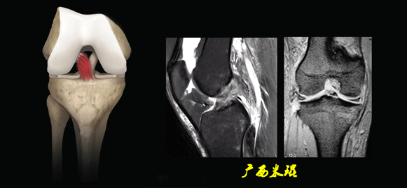 干货：高清动图学前交叉韧带MRI诊断，经典珍藏版！