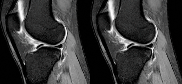 干货：高清动图学前交叉韧带MRI诊断，经典珍藏版！