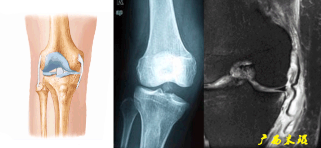 干货：高清动图学前交叉韧带MRI诊断，经典珍藏版！