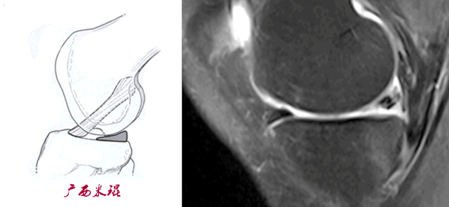 干货：高清动图学前交叉韧带MRI诊断，经典珍藏版！
