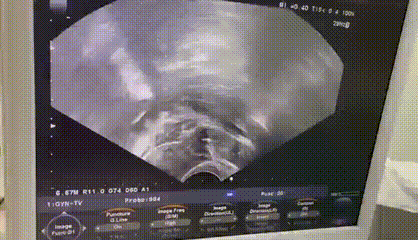 取卵针长什么样取卵针那么长，取卵手术真的无痛吗？_https://www.jmylbn.com_新闻资讯_第8张