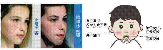 儿童鼾症-腺样体面容