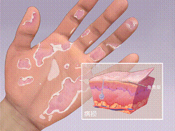 剥脱性角质松解症