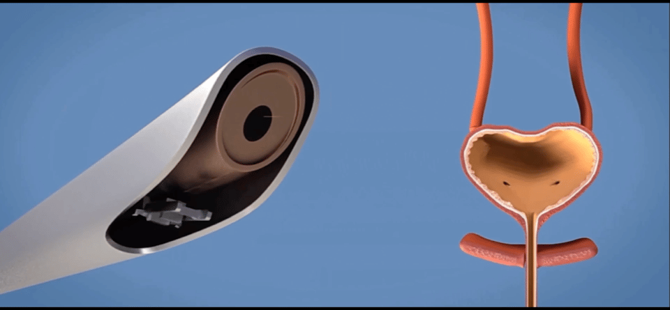 b膀胱镜为什么消毒泌尿外科的第三只眼睛——膀胱镜_https://www.jmylbn.com_新闻资讯_第1张