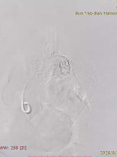 gore医疗怎么样「胸有乾坤」千钧一发 转危为安——Gore TBE治疗急诊破裂TAA一例_https://www.jmylbn.com_新闻资讯_第21张