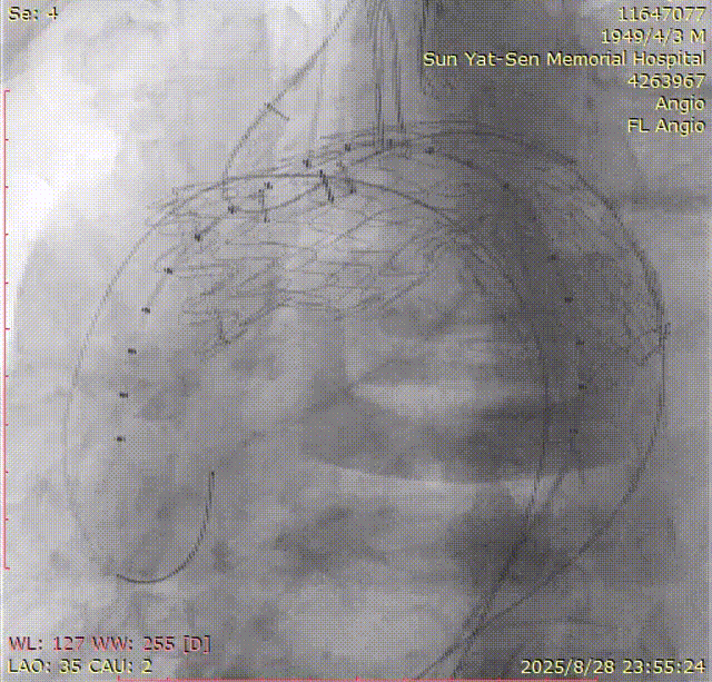gore医疗怎么样「胸有乾坤」千钧一发 转危为安——Gore TBE治疗急诊破裂TAA一例_https://www.jmylbn.com_新闻资讯_第16张