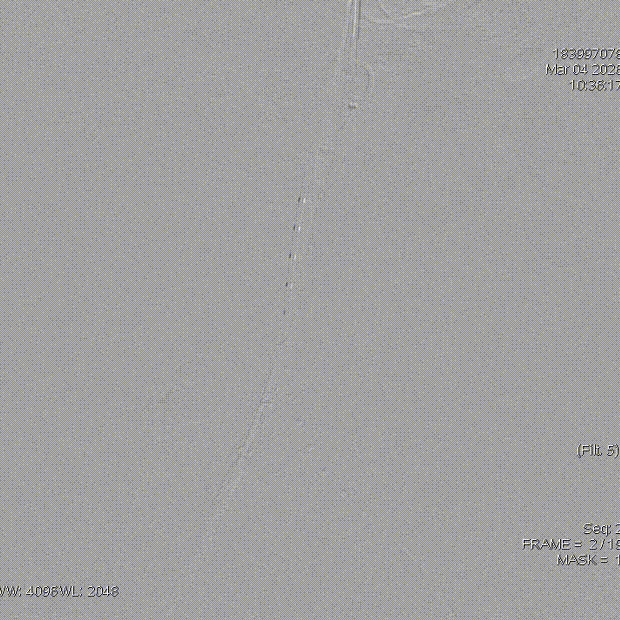 单猪尾支架怎么放【腹具匠新】吴华平教授团队：ENDURANT IIs 分叉支架开窗束径保留 IMA 治疗腹主动脉穿透性溃疡_https://www.jmylbn.com_新闻资讯_第28张