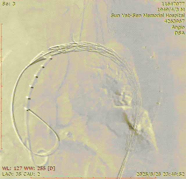 gore医疗怎么样「胸有乾坤」千钧一发 转危为安——Gore TBE治疗急诊破裂TAA一例_https://www.jmylbn.com_新闻资讯_第15张