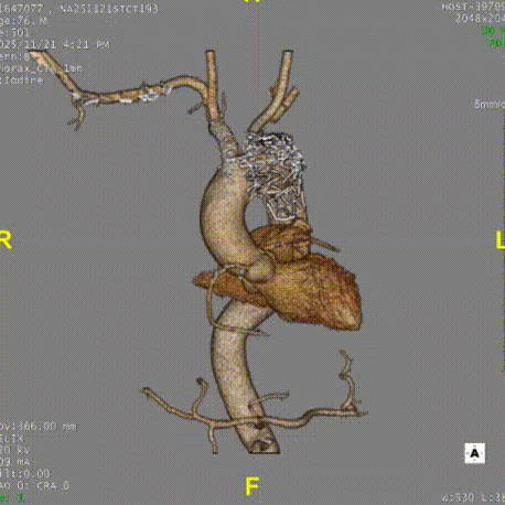 gore医疗怎么样「胸有乾坤」千钧一发 转危为安——Gore TBE治疗急诊破裂TAA一例_https://www.jmylbn.com_新闻资讯_第23张