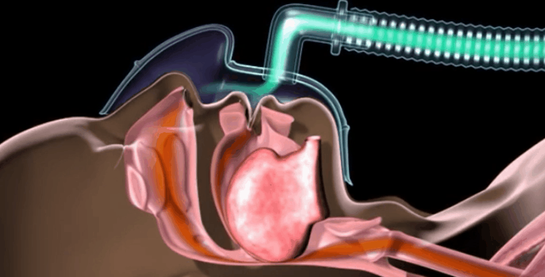 呼吸机怎么换氧气呼吸机里出来的是氧气吗？_https://www.jmylbn.com_新闻资讯_第15张