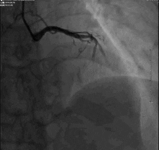 冠状动脉造影？没那么难，这样教你弄懂！