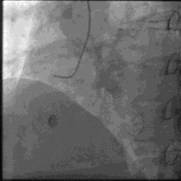 冠状动脉造影？没那么难，这样教你弄懂！