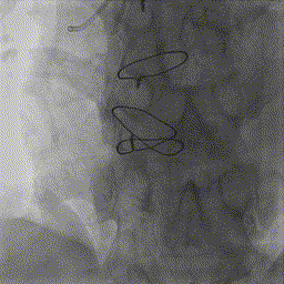冠状动脉造影？没那么难，这样教你弄懂！