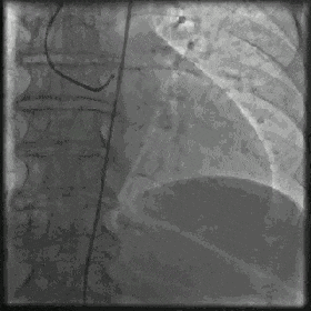 冠状动脉造影？没那么难，这样教你弄懂！