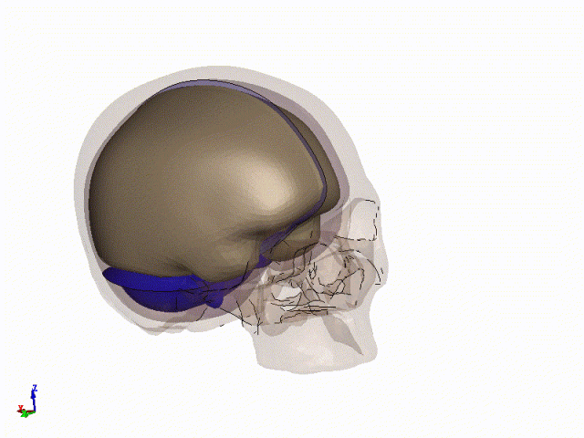 LS-DYNA | 爆炸冲击波对人体头颅作用的图9