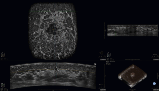 什么是超声容积探头乳腺超声诊断有“神器”——自动乳腺全容积超声成像_https://www.jmylbn.com_新闻资讯_第7张