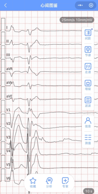 数字心电图怎么使用【心电图收藏家指南】心阅图鉴小程序焕新升级：革新存图方式，打造专属数字化心电图库！_https://www.jmylbn.com_新闻资讯_第7张