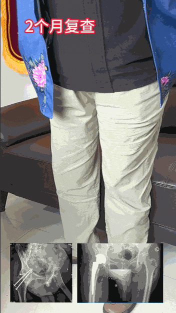 34张图文详解：21年融合髋THA的几点体会