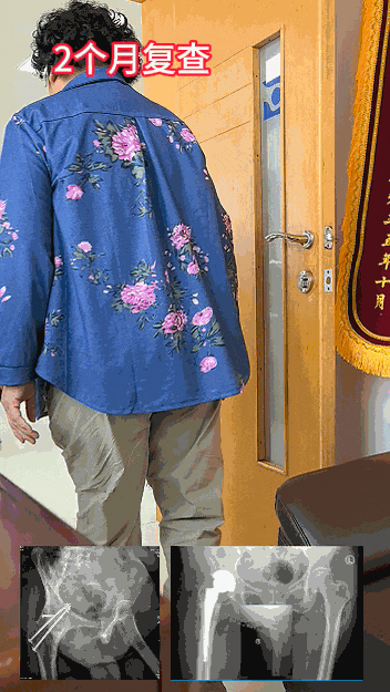 34张图文详解：21年融合髋THA的几点体会