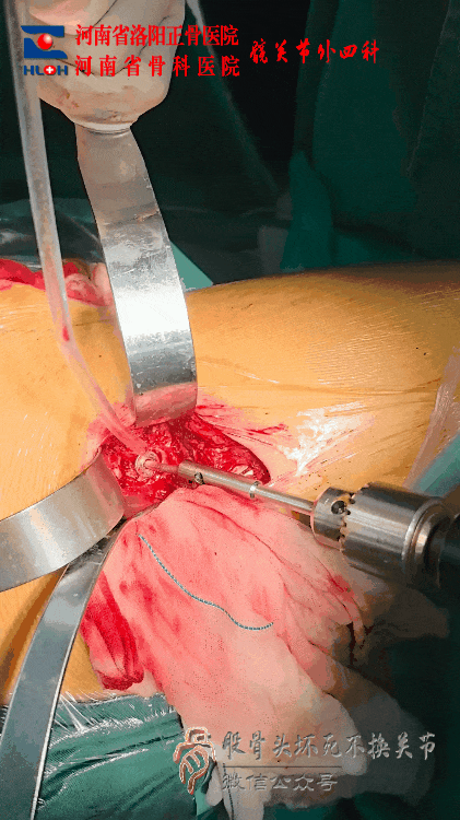 34张图文详解：21年融合髋THA的几点体会