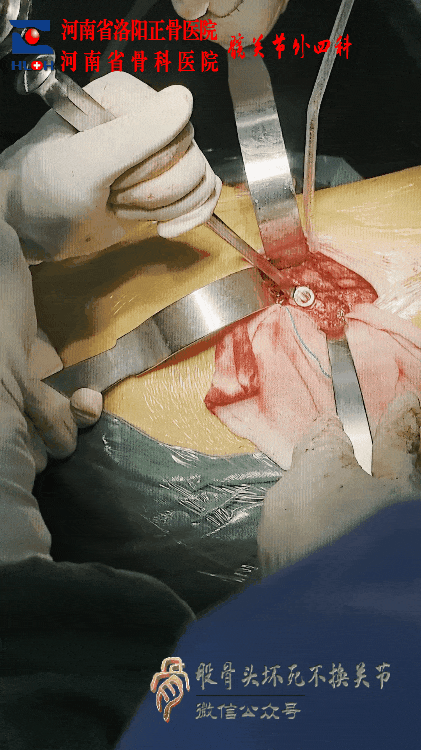 34张图文详解：21年融合髋THA的几点体会