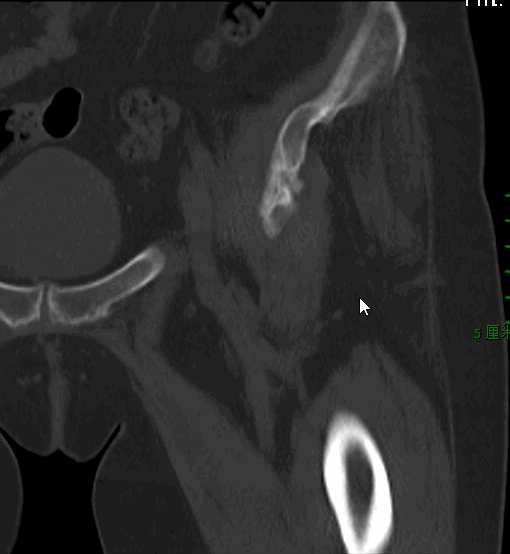 髋臼骨折4块板15颗钉，关节怎么换？