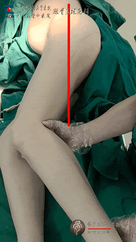 髋臼骨折4块板15颗钉，关节怎么换？